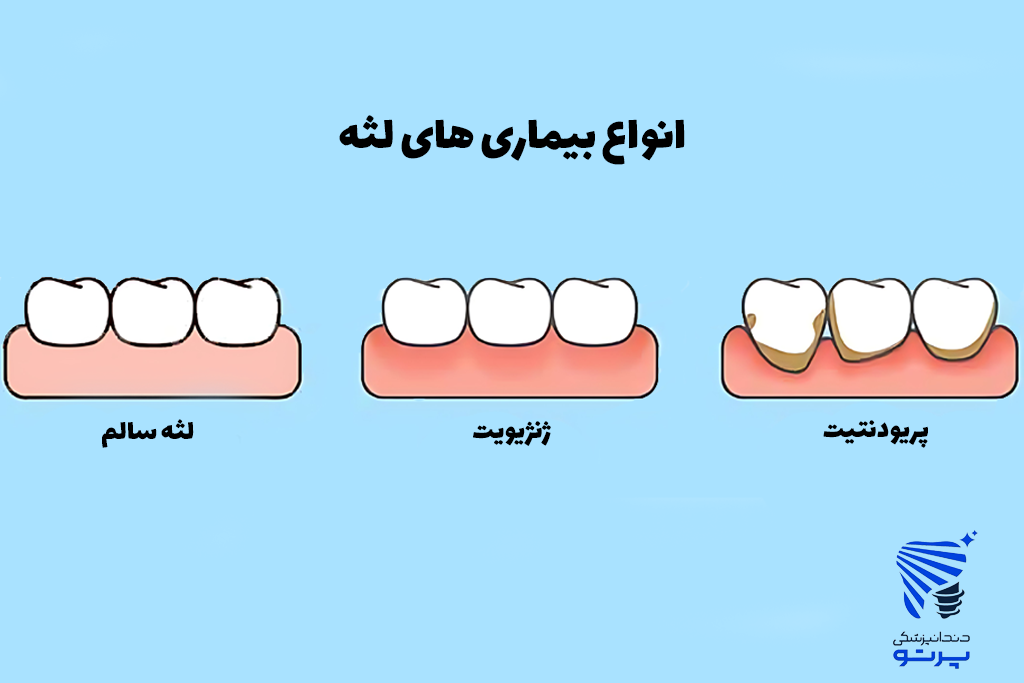 انواع بیماری لثه