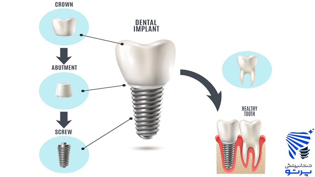 هزینه ایمپلنت دندان چقدر ؟