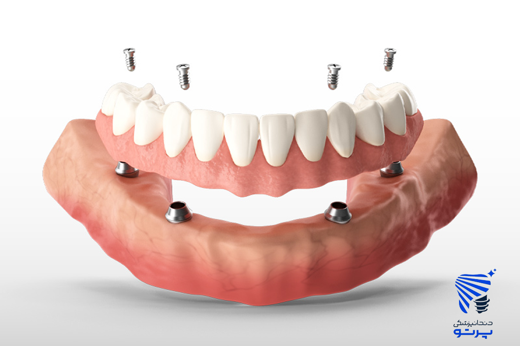 ایمپلنت دندان؛ بازگشت لبخند، اعتماد به‌ نفس