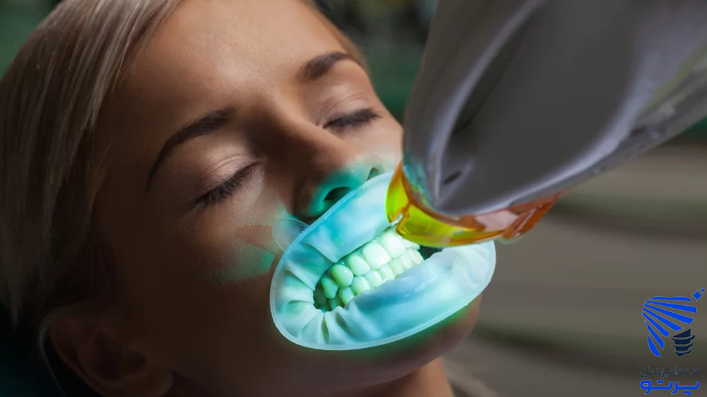 بلیچینگ در مطب