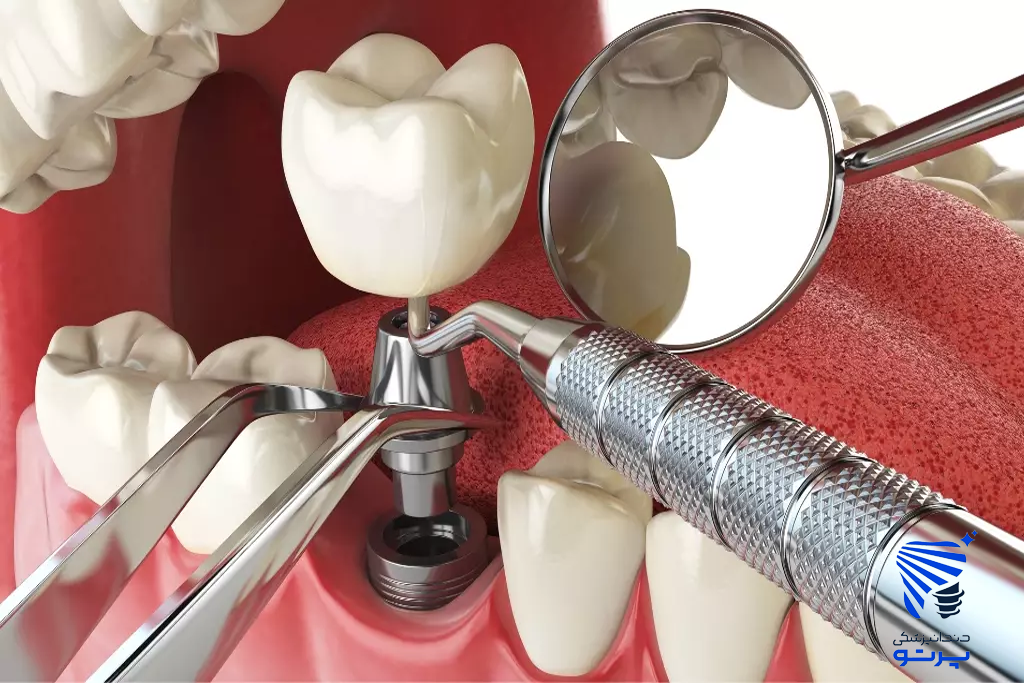 ایمپلنت فوری دندان