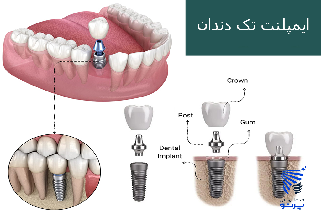 ایمپلنت تک دندان