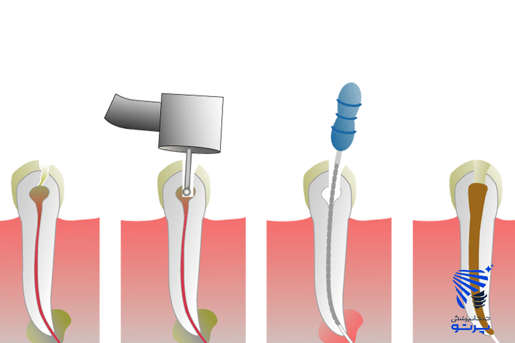 مراحل عصب کشی